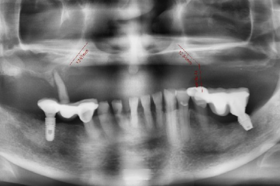 嚴重上顎骨萎縮